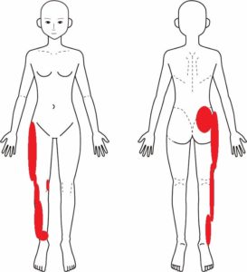 片側の腰 臀部 脚の外側 足首の痛み 多治見市の整体 外出困難な重症者 子育て中の女性宅へ訪問
