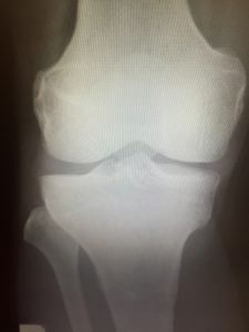 正常な右膝関節