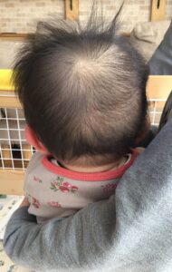 赤ちゃん頭蓋矯正　絶壁