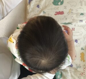 赤ちゃん頭蓋矯正　絶壁頭・左右不均等