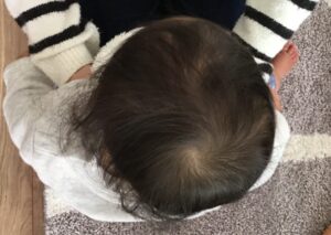 赤ちゃん頭蓋骨の変形・斜頭症