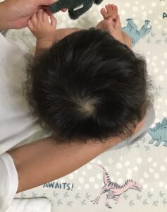 赤ちゃん頭のかたち矯正絶壁頭