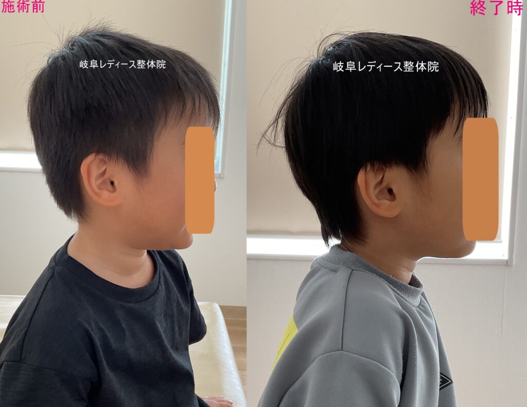 子ども頭のかたち矯正 斜頭症・前頭部と頭頂部の凹み・絶壁頭・斜頸症 4歳 | 女性とお子さま専門 岐南町・岐阜市の整体 赤ちゃんから高齢者まで ...