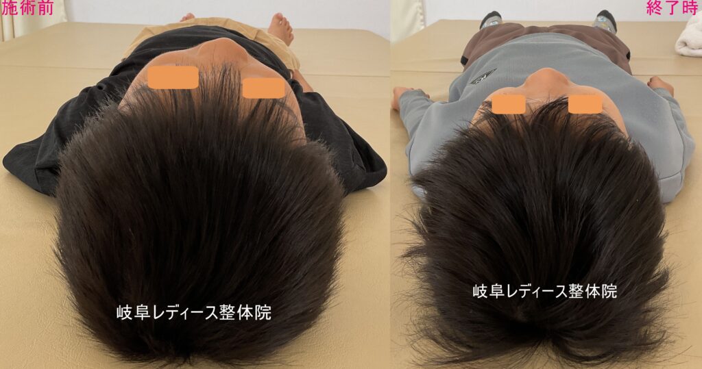４歳　斜頭症