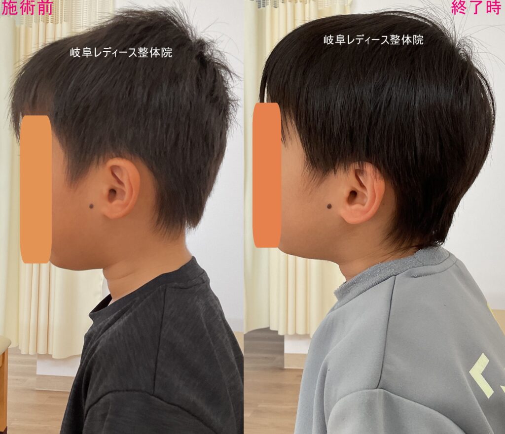 頭頂部の凹み・絶壁頭