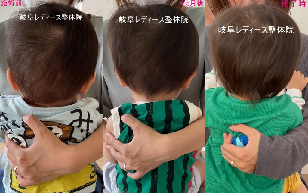 絶壁頭・ハチ張り