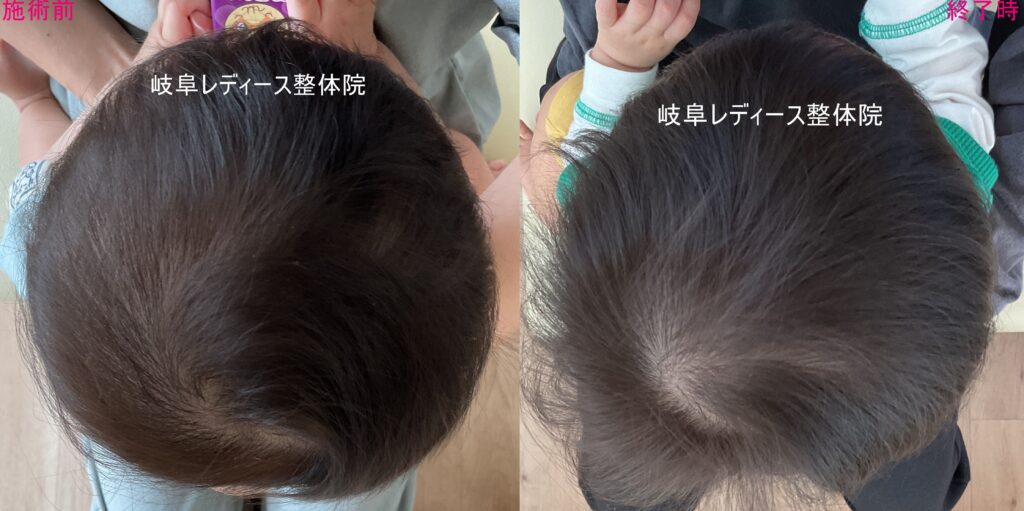 絶壁頭・ハチ張り