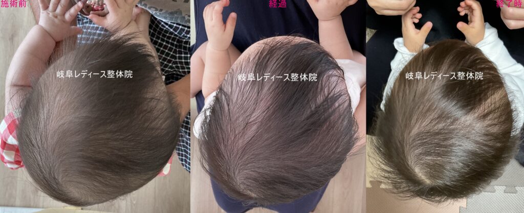 斜頭症