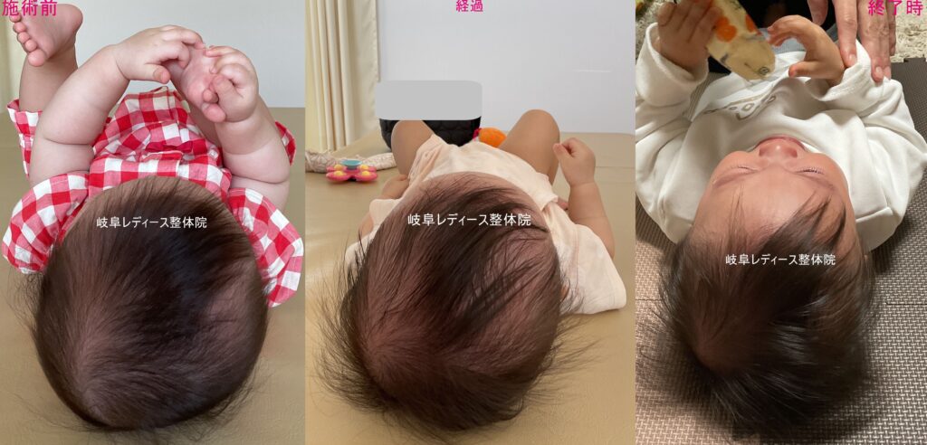 斜頭症・絶壁頭