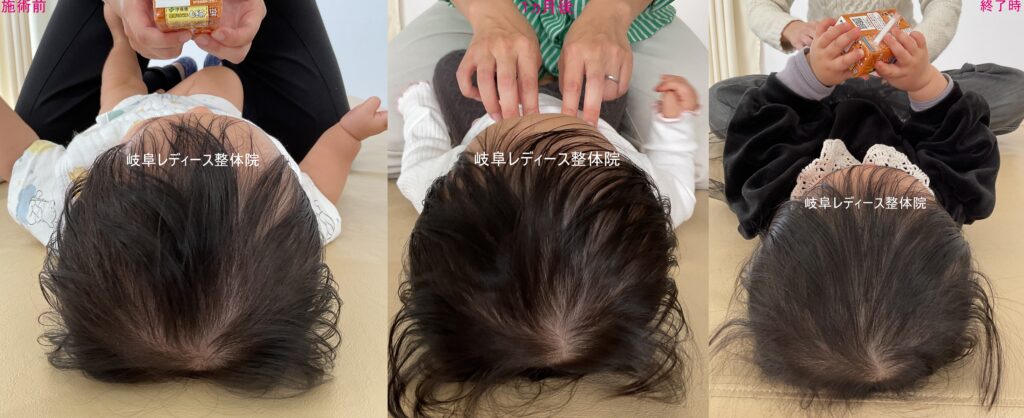 ハチ張り・斜頭症・絶壁頭・おでこの凹み
