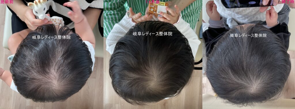 ハチ張り・斜頭症・絶壁頭
