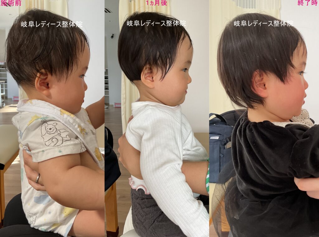 頭の前屈・絶壁頭