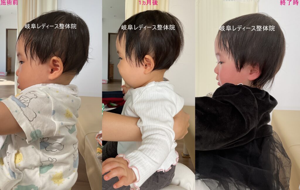 頭の前屈・絶壁頭