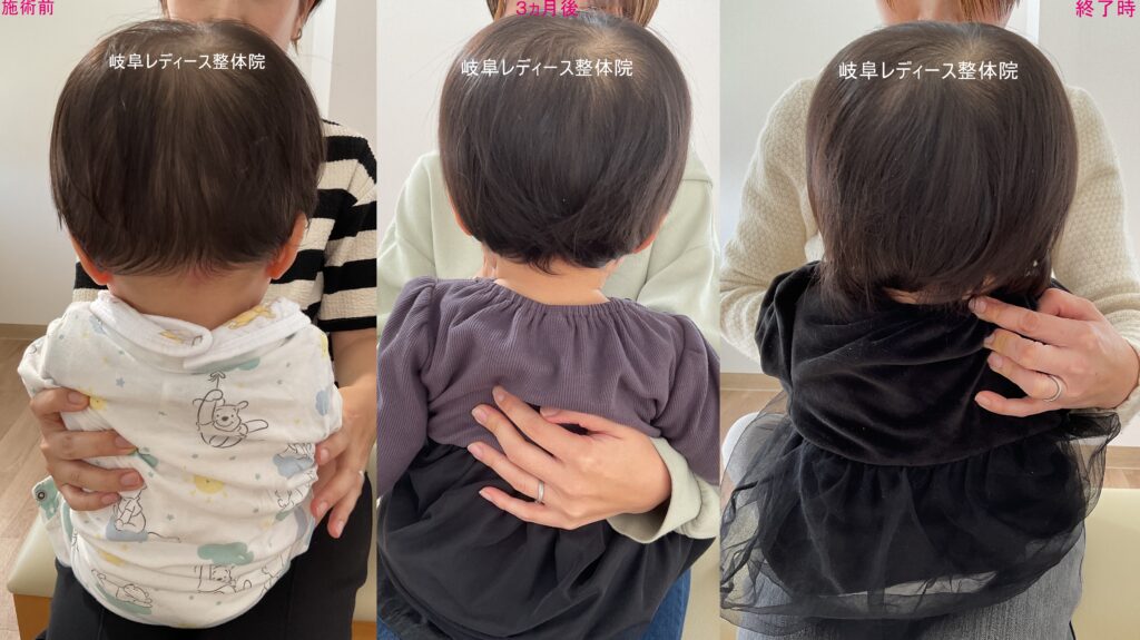 ハチ張り・絶壁頭