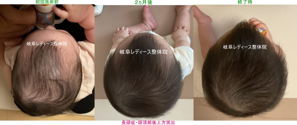 長頭症・頭頂部後上方突出