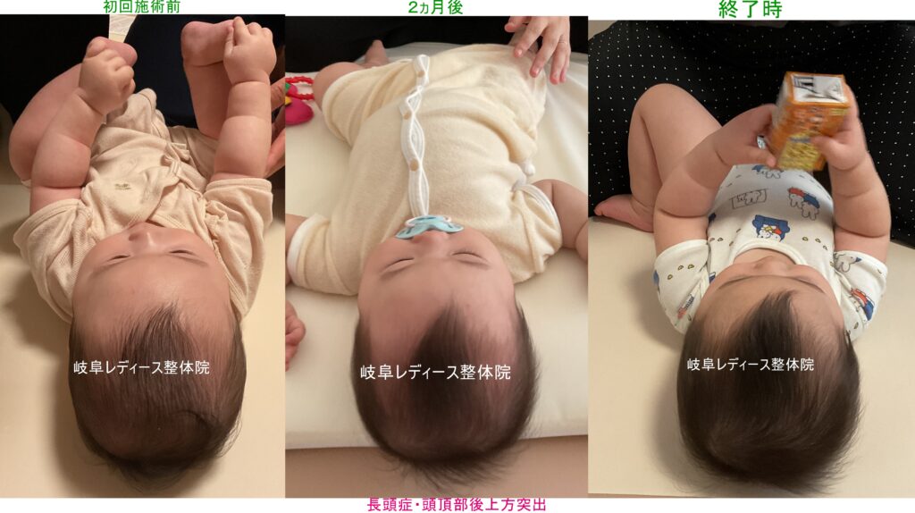 長頭症・頭頂部後上方突出