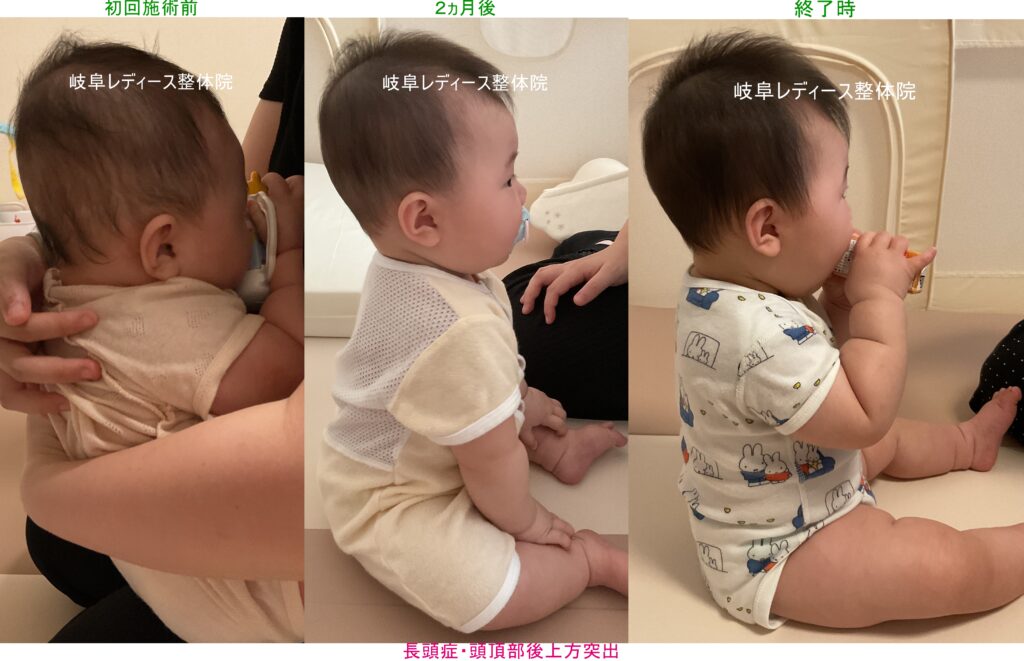 長頭症・頭頂部後上方突出