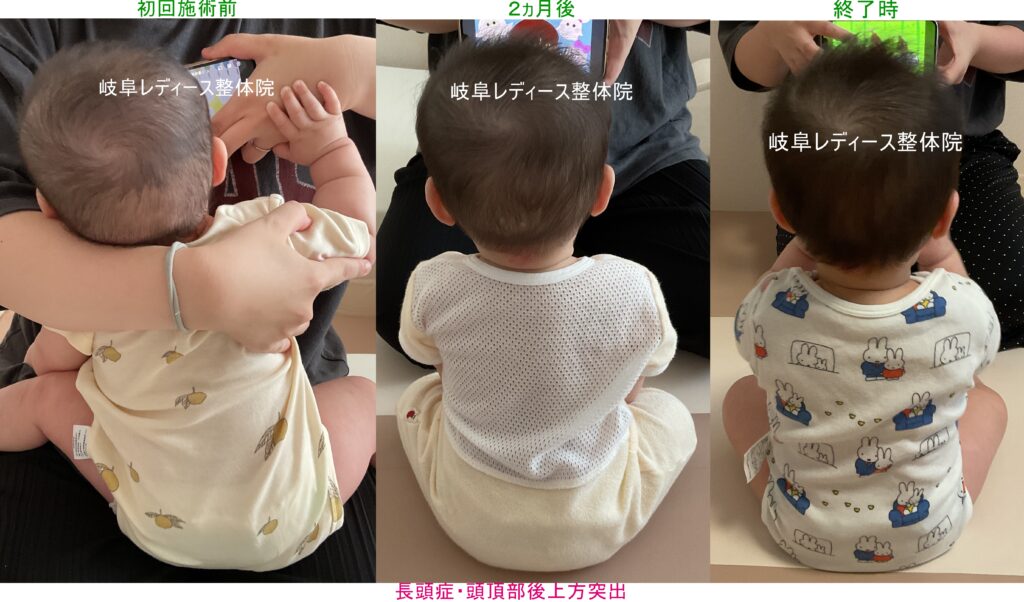 長頭症・頭頂部後上方突出