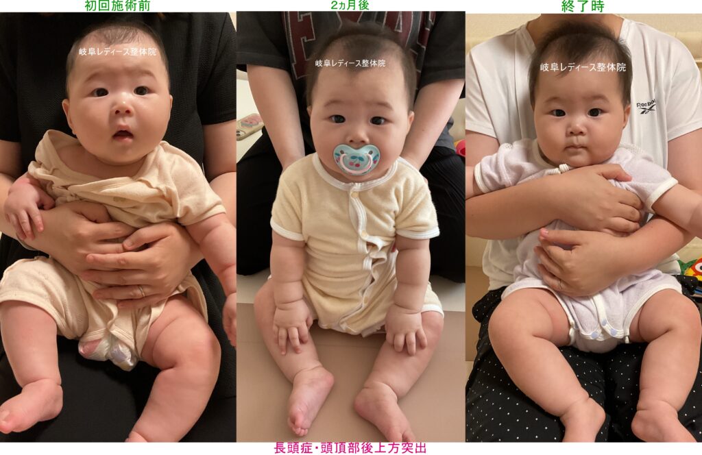 長頭症・頭頂部後上方突出