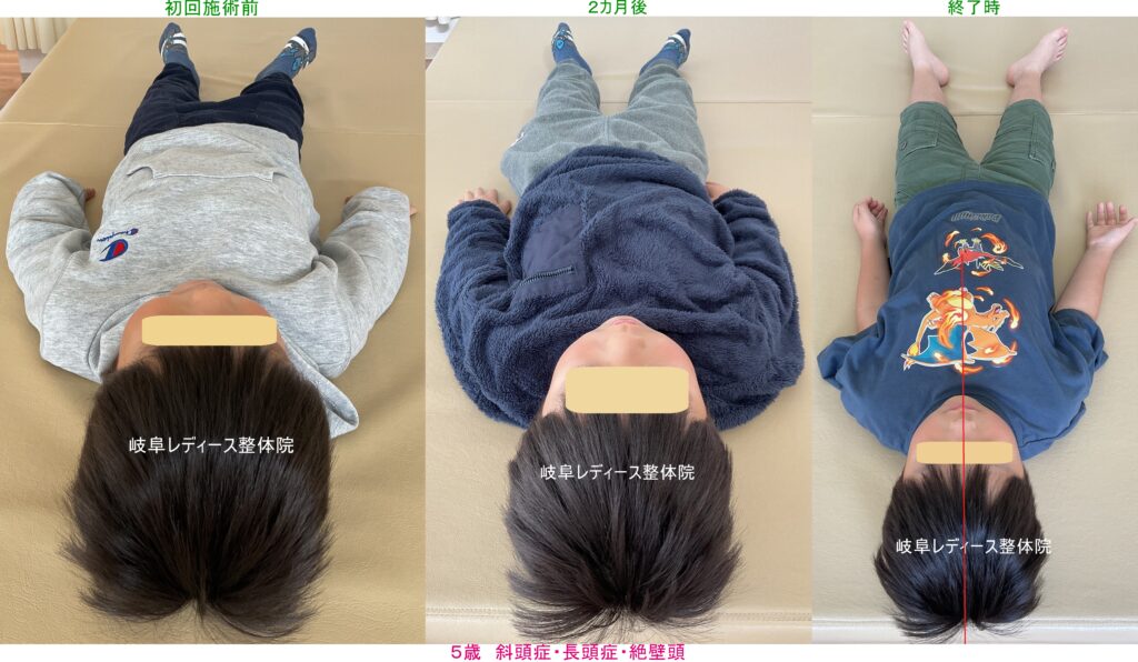 ５歳　斜頭症・長頭症・絶壁頭・側弯症