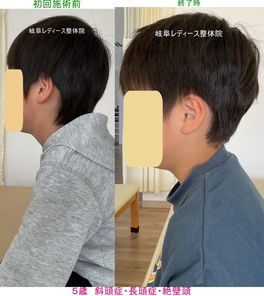 ５歳　斜頭症・長頭症・絶壁頭