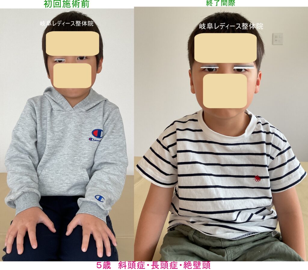 ５歳　斜頭症・長頭症・絶壁頭・側弯症