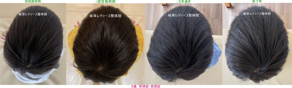 ５歳　斜頭症・長頭症・絶壁頭