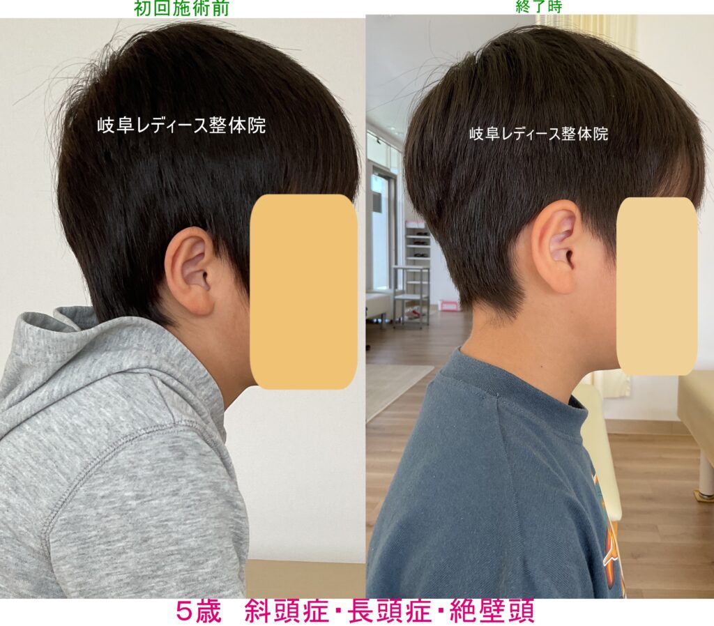 ５歳　斜頭症・長頭症・絶壁頭