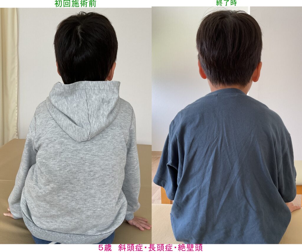 ５歳　斜頭症・長頭症・絶壁頭・側弯症