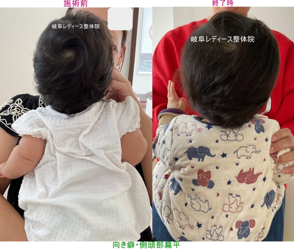 向き癖・側頭部の扁平