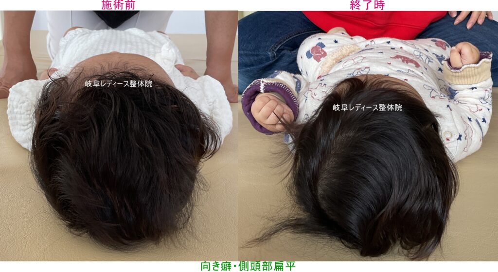 向き癖・側頭部扁平