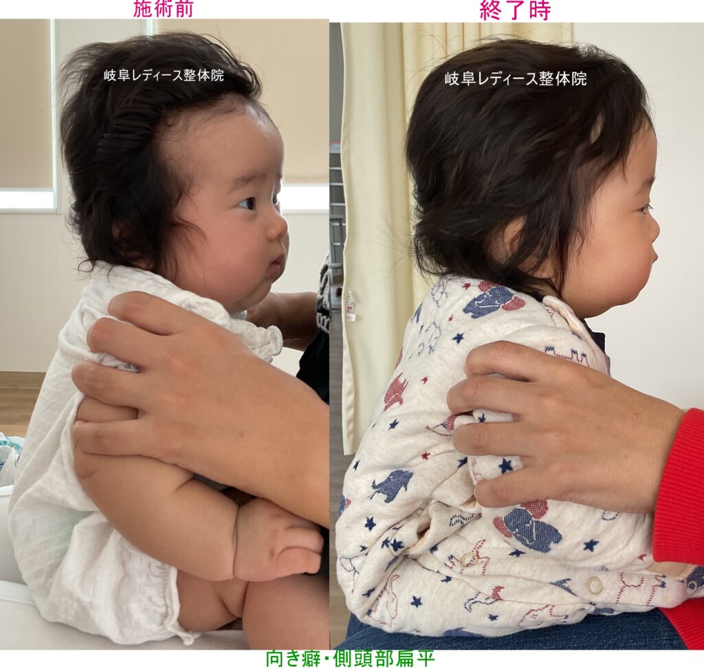 向き癖・側頭部扁平