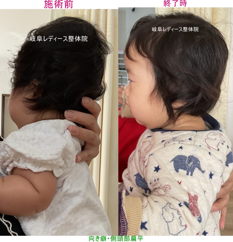 向き癖・側頭部の扁平