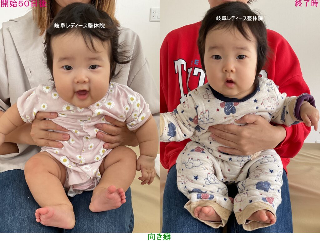 向き癖・側頭部の扁平