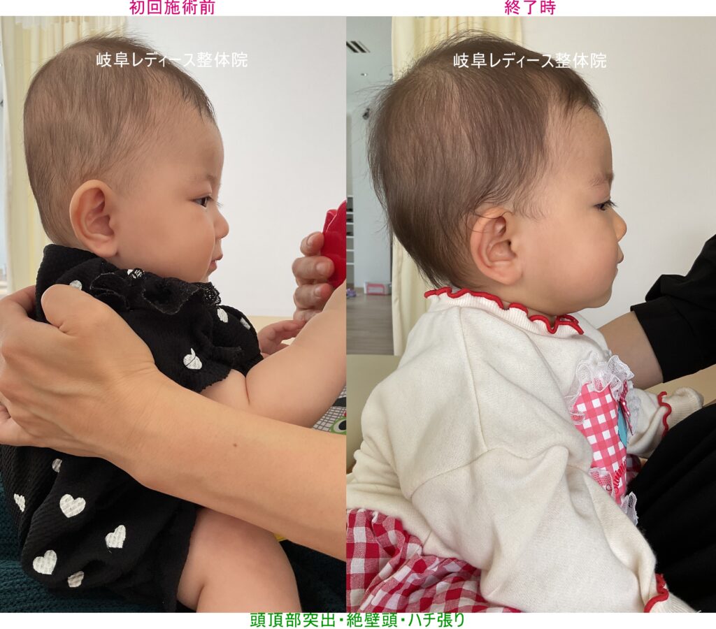 頭頂部突出・絶壁頭・ハチ張り