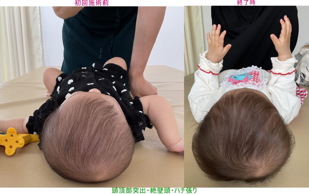 頭頂部突出・絶壁頭・ハチ張り