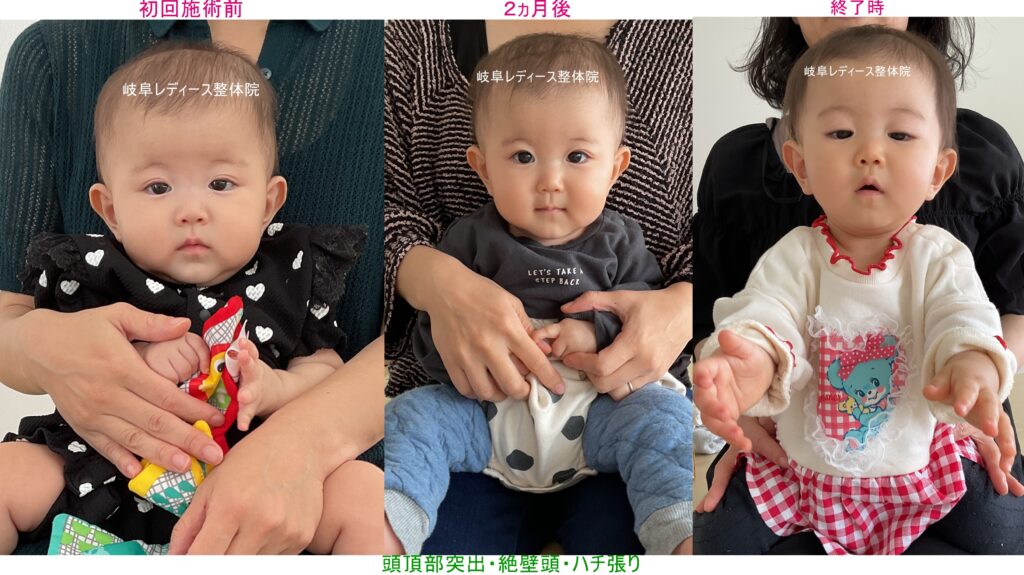 頭頂部突出・絶壁頭・ハチ張り