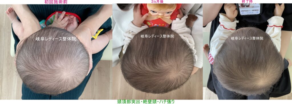 頭頂部突出絶壁ハチ張り