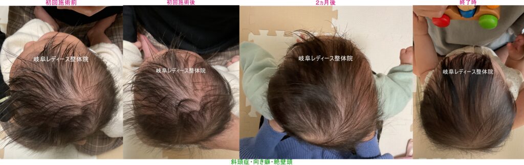 斜頭症・向き癖・絶壁頭