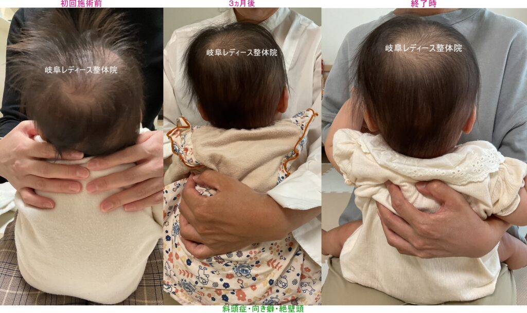 斜頭症・向き癖・絶壁頭