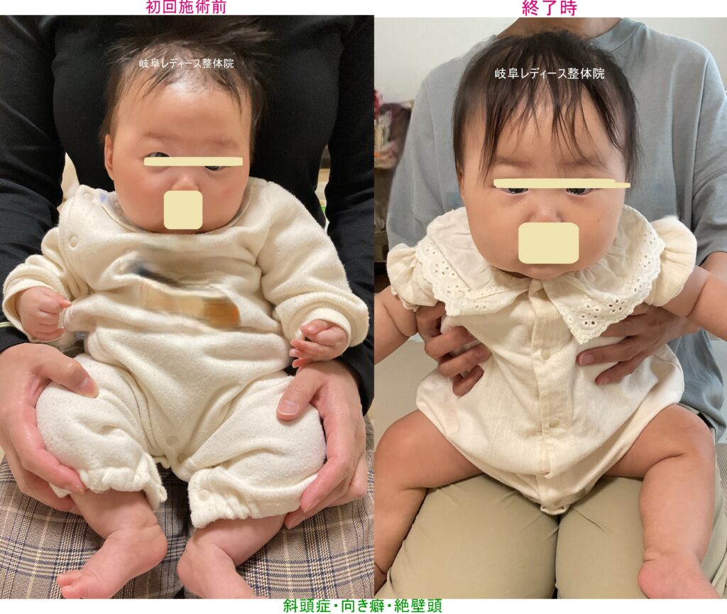 斜頭症・向き癖・絶壁頭