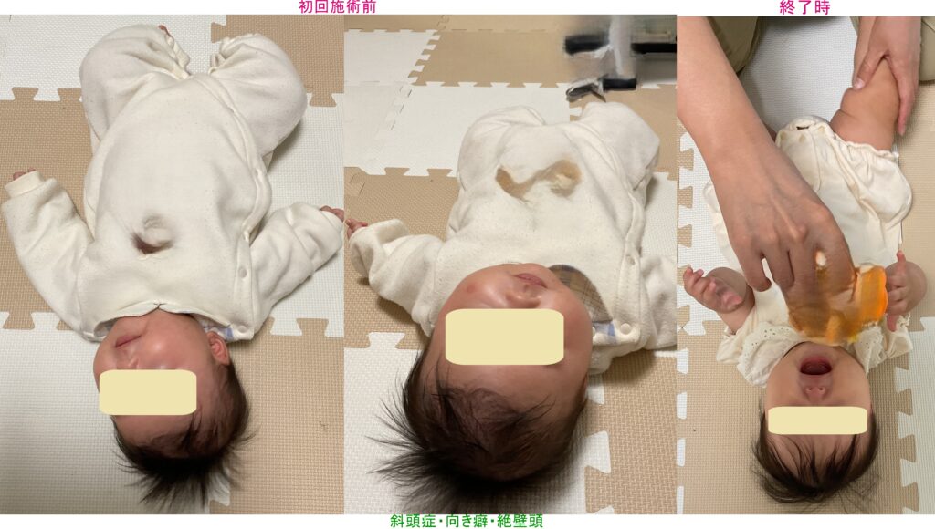 斜頭症　向き癖　絶壁頭