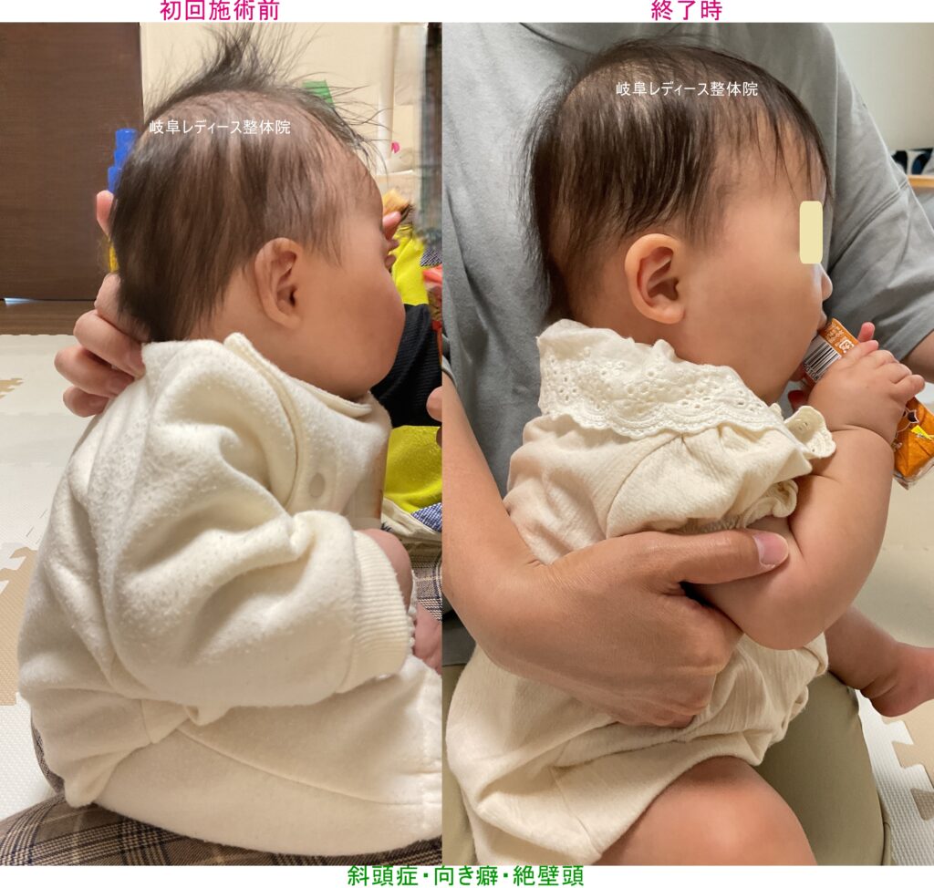 斜頭症・向き癖・絶壁頭