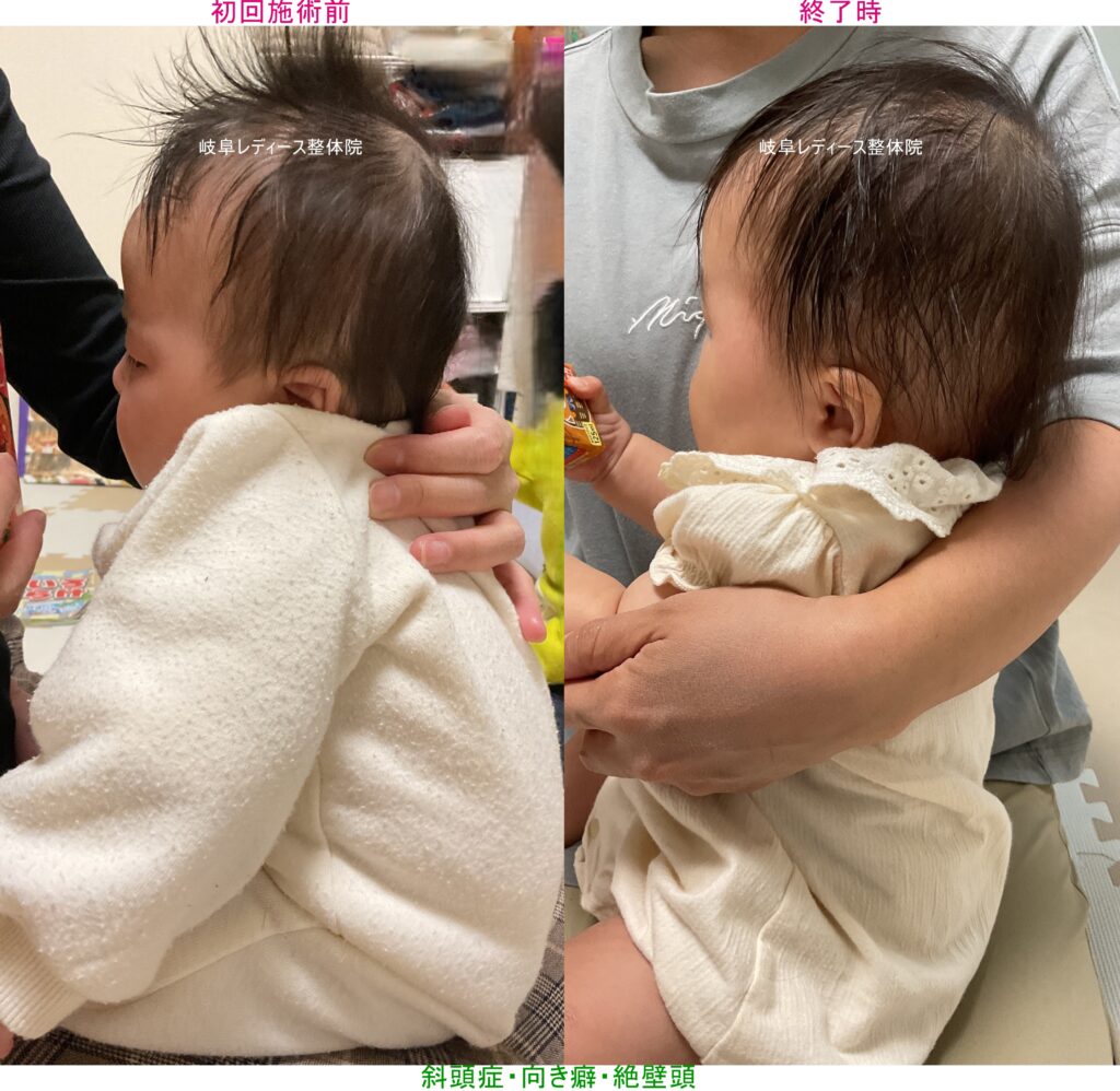 斜頭症・向き癖・絶壁