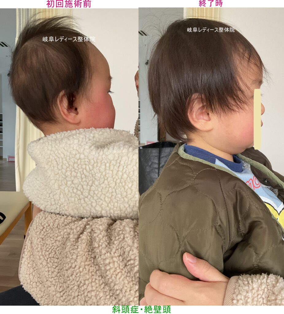 斜頭症・絶壁頭